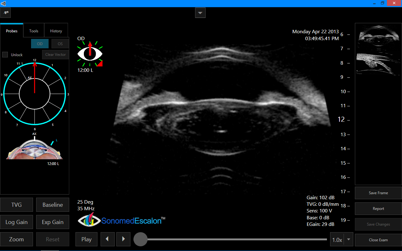 Ophthalmic Equipment | Sonomed VuPad Portable B-Scan Ultrasound ...