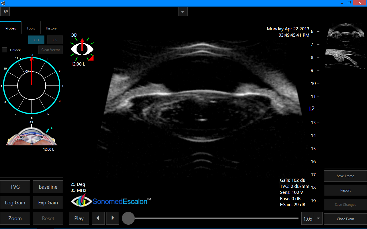 Ophthalmic Equipment | Sonomed VuPad Portable A/B-Scan Ultrasound ...